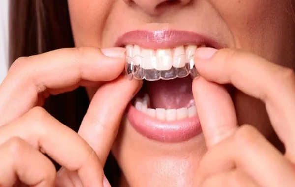 Clear Aligners in India for Overseas Patients: AI Planning, Remote Monitoring and Safe Case Selection