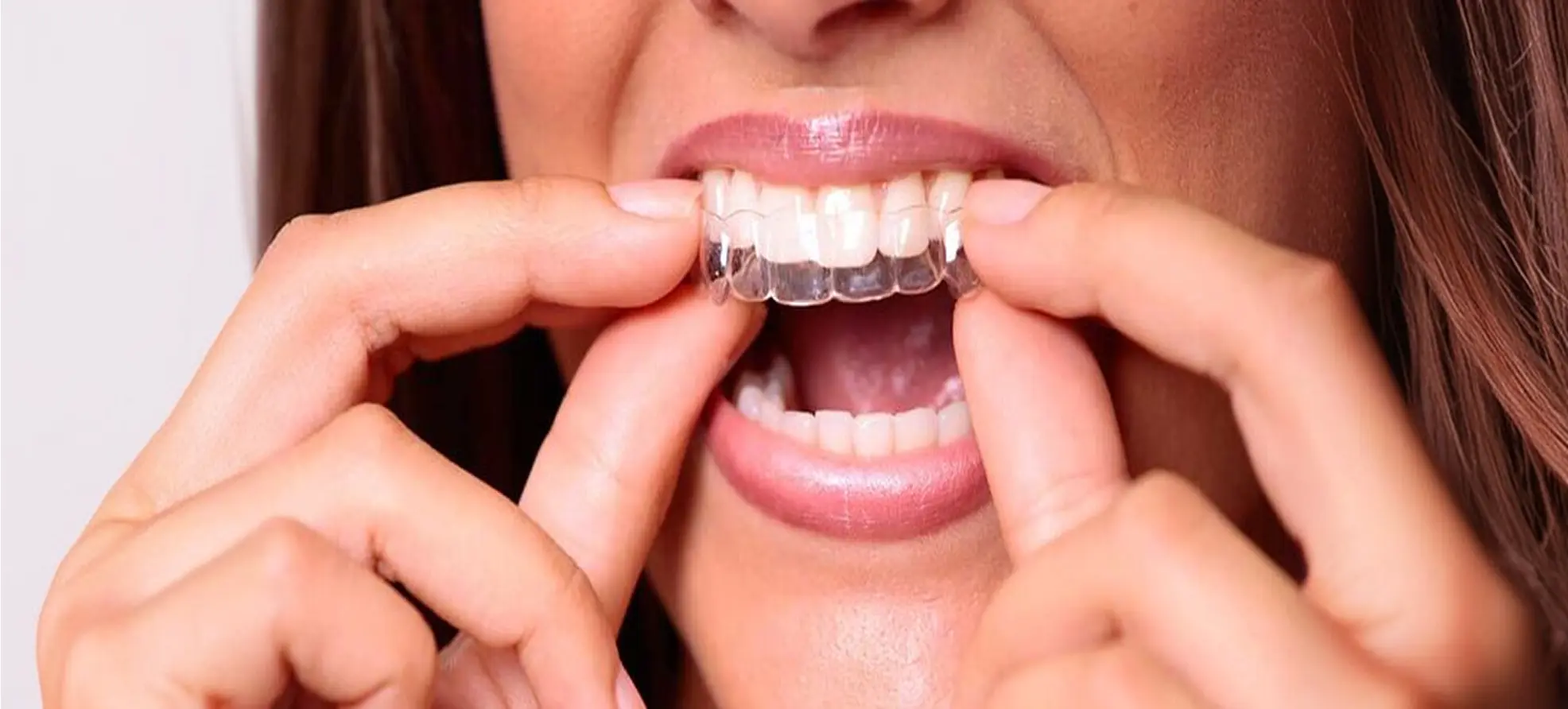Clear Aligners in India for Overseas Patients: AI Planning, Remote Monitoring and Safe Case Selection