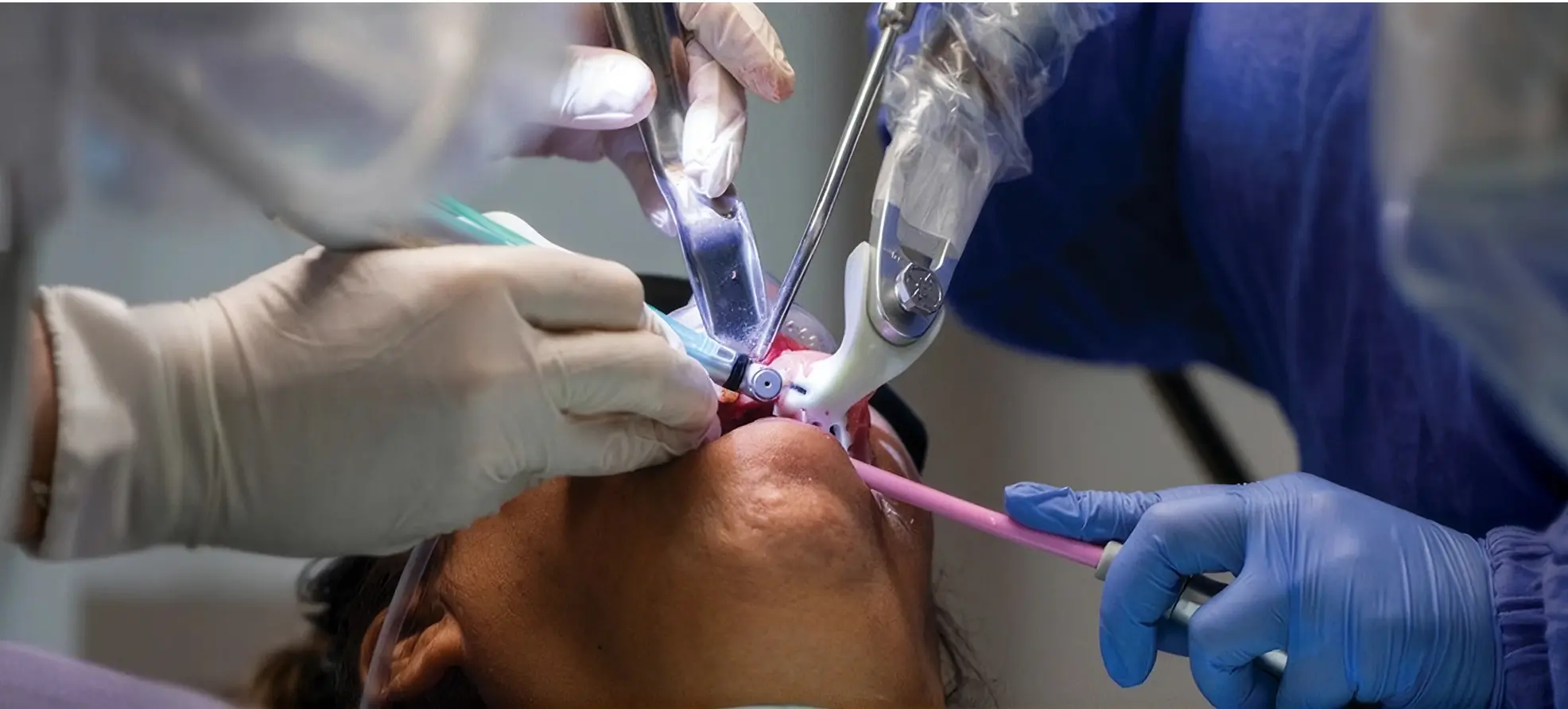 Navigation-Assisted Dental Implants in India: The Truth About ‘Robotic’ Implant Surgery